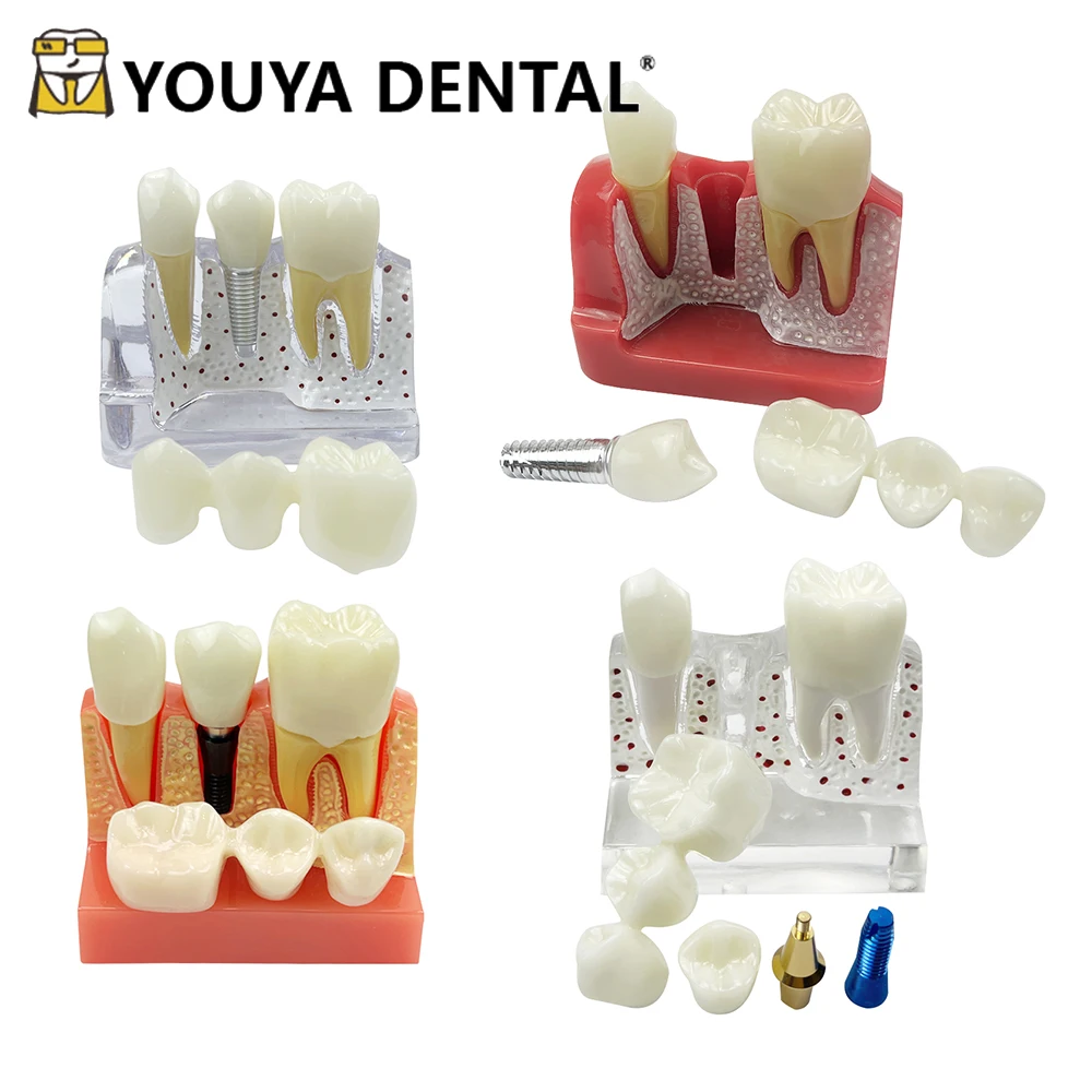

4-кратная модель имплантации зубов, мост для зубных протезов, корона, фарфоровая модель для реставрации для стоматолога, студенческий обучающий демонстрационный модуль