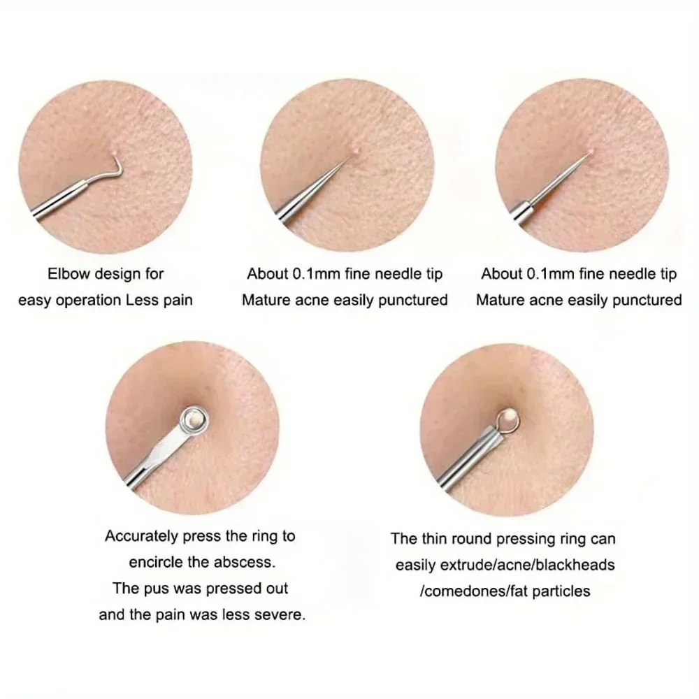 4 teile/los Edelstahl Mitesser Entferner Extraktion Pickel Komedonen Akne Extractor Whitehead Blemish Kit