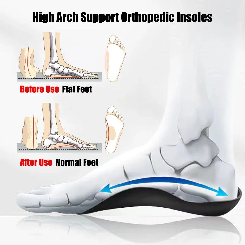 Orthotic Insoles for Plantar Fasciitis Pain Relief Therapy Flat Feet Arch Support Insoles for Shoes Women Men XO-Legs Corrector