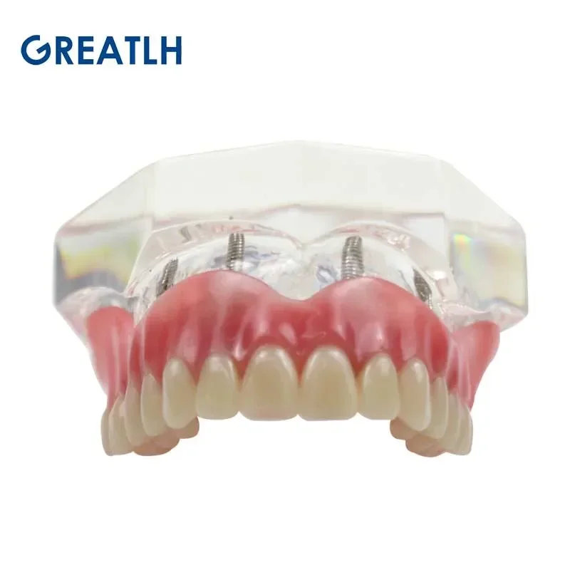 Dental Teeth Model with Implant Overdenture Inferior Demo Mandibular Model Dentist Student Learning Model