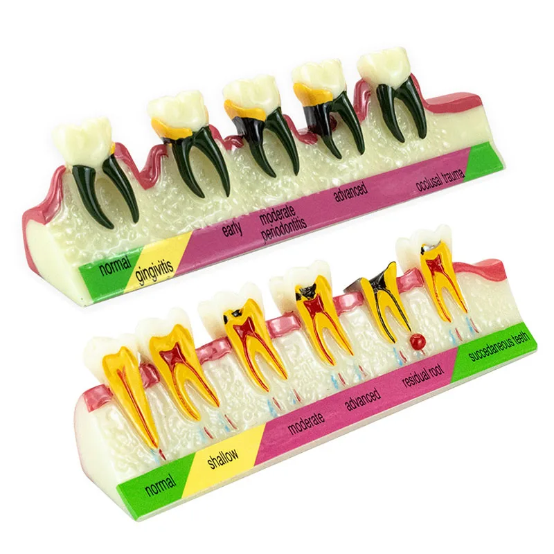 Dental Model Teeth Periodontal Disease Model Assort Demo Caries Model Dentist Teaching Training Doctor-patient Communication