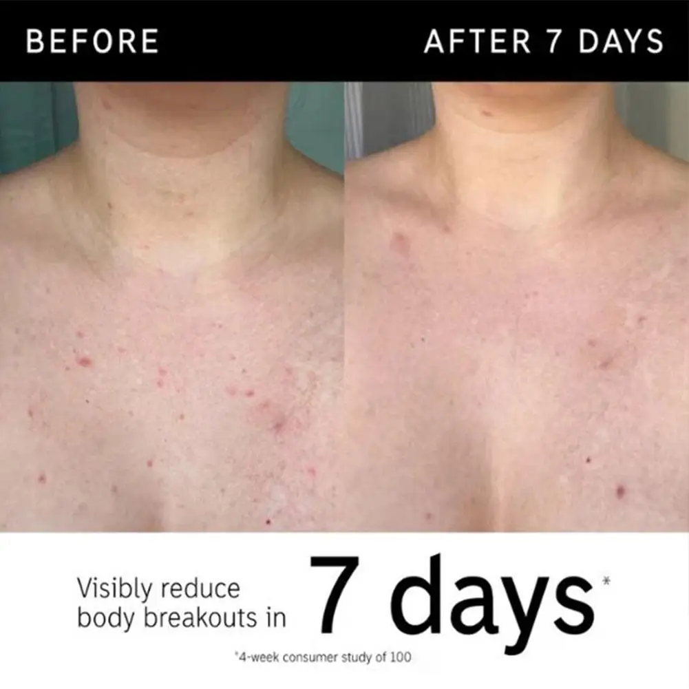 Glykolsäure-Peeling-Stick von The INKEY List, Körperglättender Peeling-Stick für Keratosis Pilaris und ungleichmäßige Hautstruktur – Detail 14