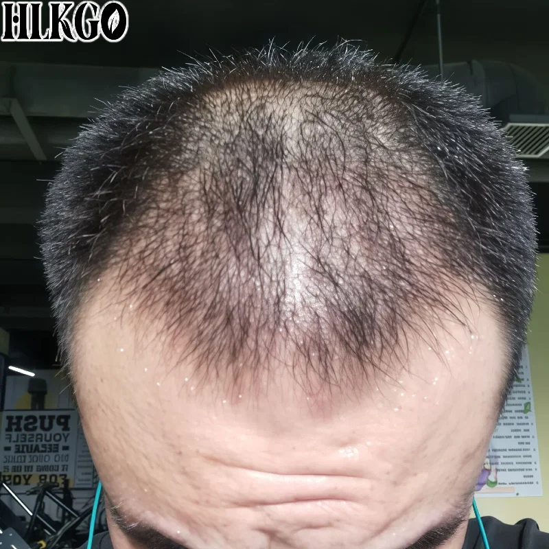 

Профессиональный лазерный шлем 650 нм для стимуляции роста волос, 300-диодная кепка для стимуляции волосяных фолликулов, для более густых волос