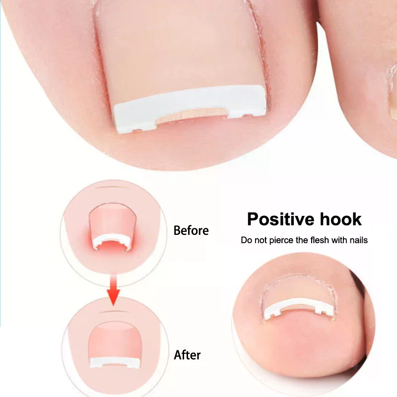 Corrector de uñas encarnadas, herramientas para pedicura, recuperación integrada, tratamiento profesional de uñas encarnadas, cuidado de los pies, 1 Uds.