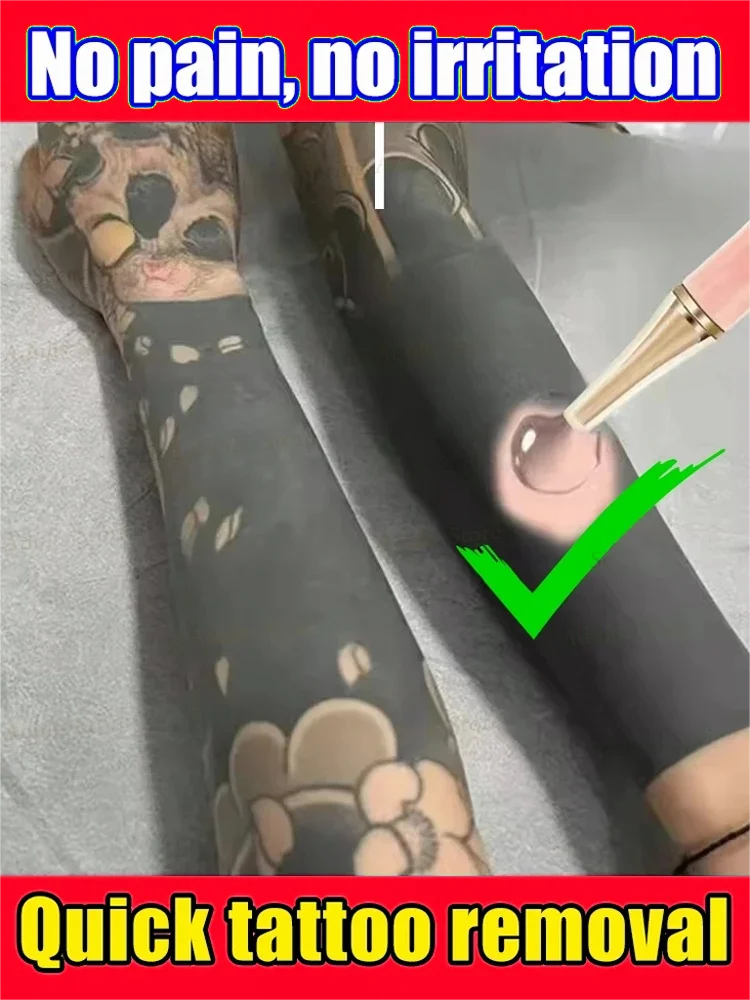 كريم إزالة الوشم، مناسب للوشم الكبير والصغير، فعال في إزالة الوشم الدائم