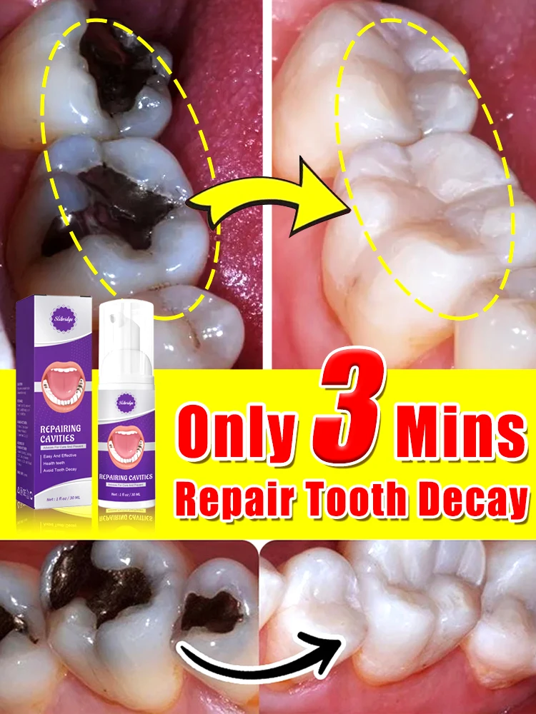 decay Tooth Repair Repairing Cavities Protect Anti caries