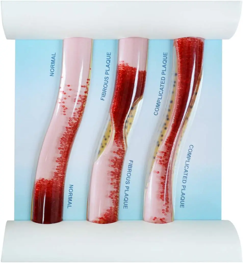 Medarchitect LDL Blood Vessel Model Low-Density Lipoprotein Drip Design Atherosclerosis Teach for Medical Student Patient Doctor