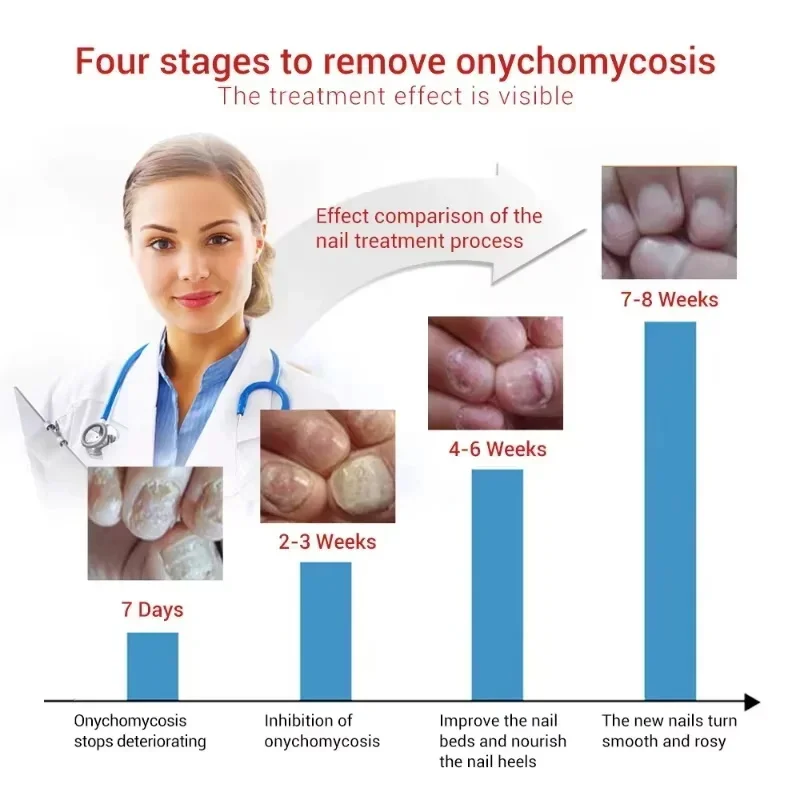 Krachtige Nagel Schimmelbehandeling Serum Anti-Infectie Voet Teen Nagel Schimmel Verwijdering Gel Onychomycosis Paronychia Reparatie Voeten Zorg