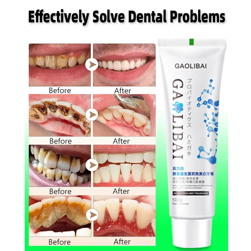 100g Tooth Restoration Toothpaste Prevents Dental Caries Toothpaste Soothes Dentine Hypersensitivity Toothpaste Fresh Breath