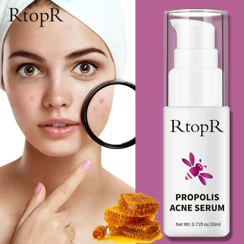 RtopR Propolis Acne Treatment Serum Repair Acne Brightening Shrink Pore Eliminates Acne Scar Spot Essence Oil control Serum 20ml