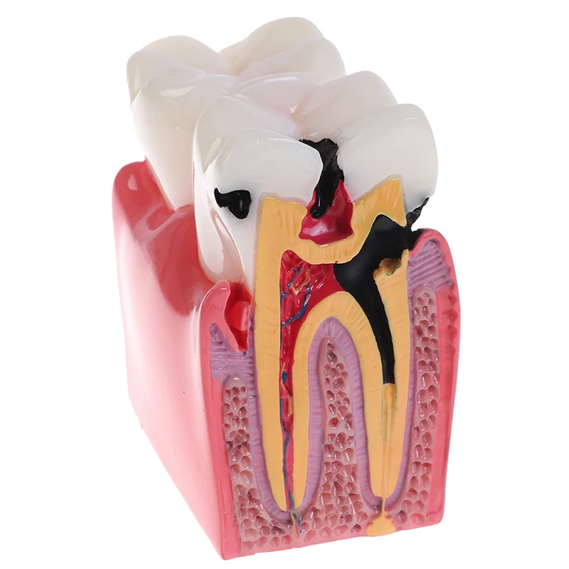 1PCS Dental Materials Lab Teeth Model 6 Times Caries Comparation Study Models For Dentist Studying and Researching