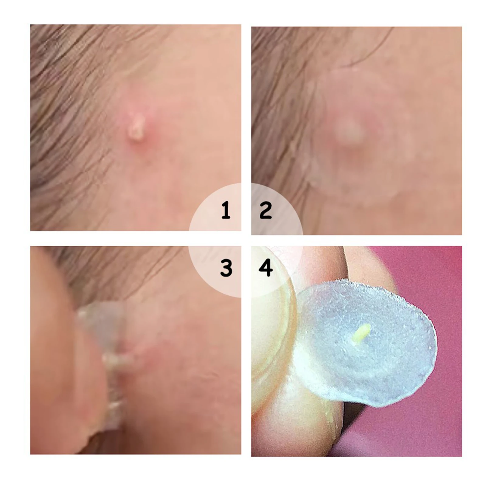 【Hot sales】72Pcs Invisible Removal Pimple Anti-Acne Hydrocolloid Patches Spots Marks Concealer Waterproof Repair Sticker image 3