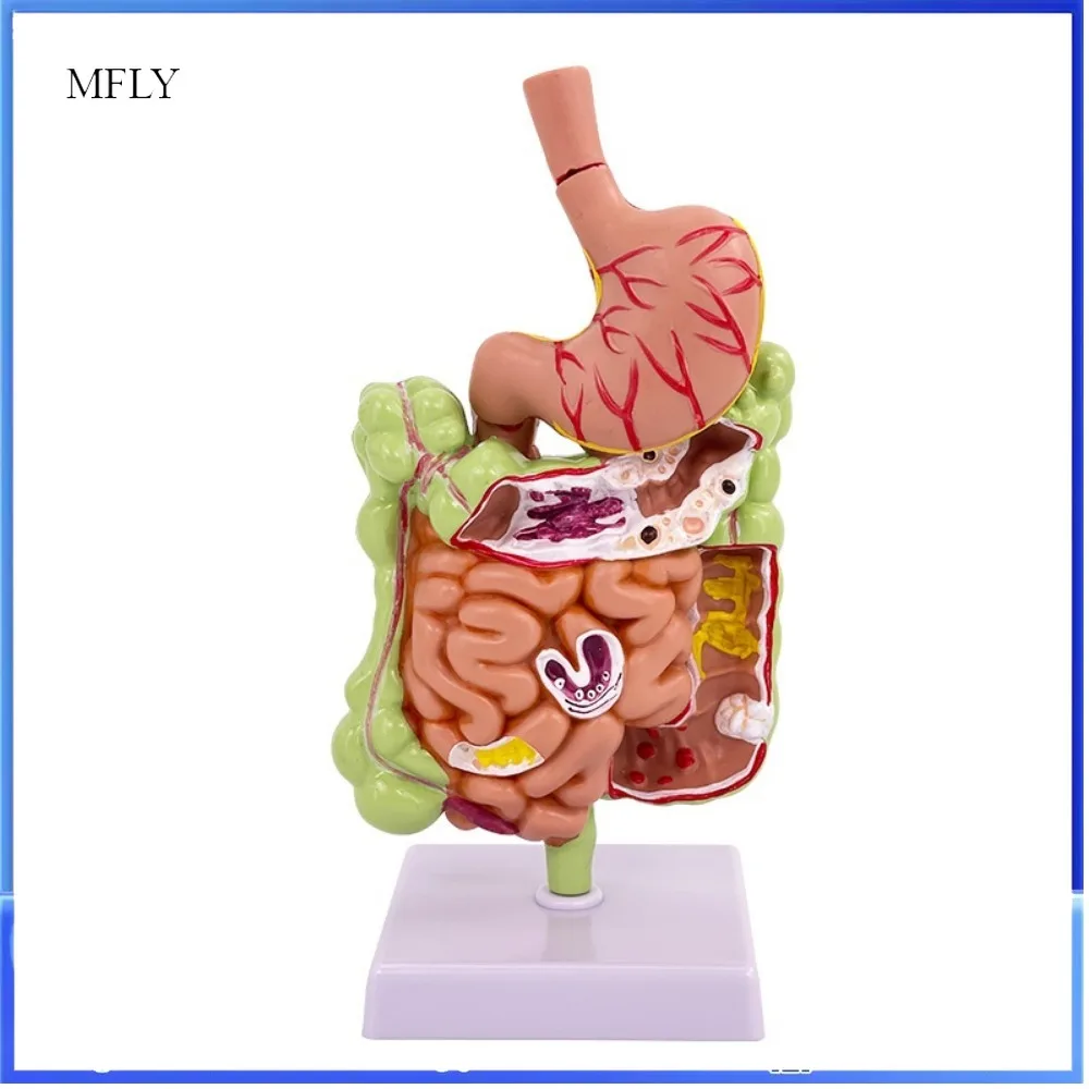 Medical Teaching Model of Human Digestive System and Large Intestine Pathology