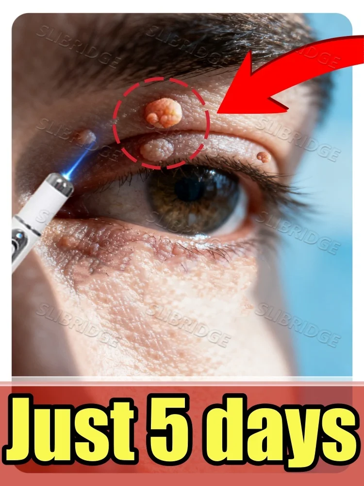 

ʟᴀsᴇʀ ᴡᴀʀᴛ ʀᴇᴍᴏᴠᴀʟ ᴛᴇᴄʜɴᴏʟᴏɢʏ: ᴘᴀɪɴʟᴇss ᴀɴᴅ sᴄᴀʀʟᴇss ɪɴ 7 ᴅᴀʏs