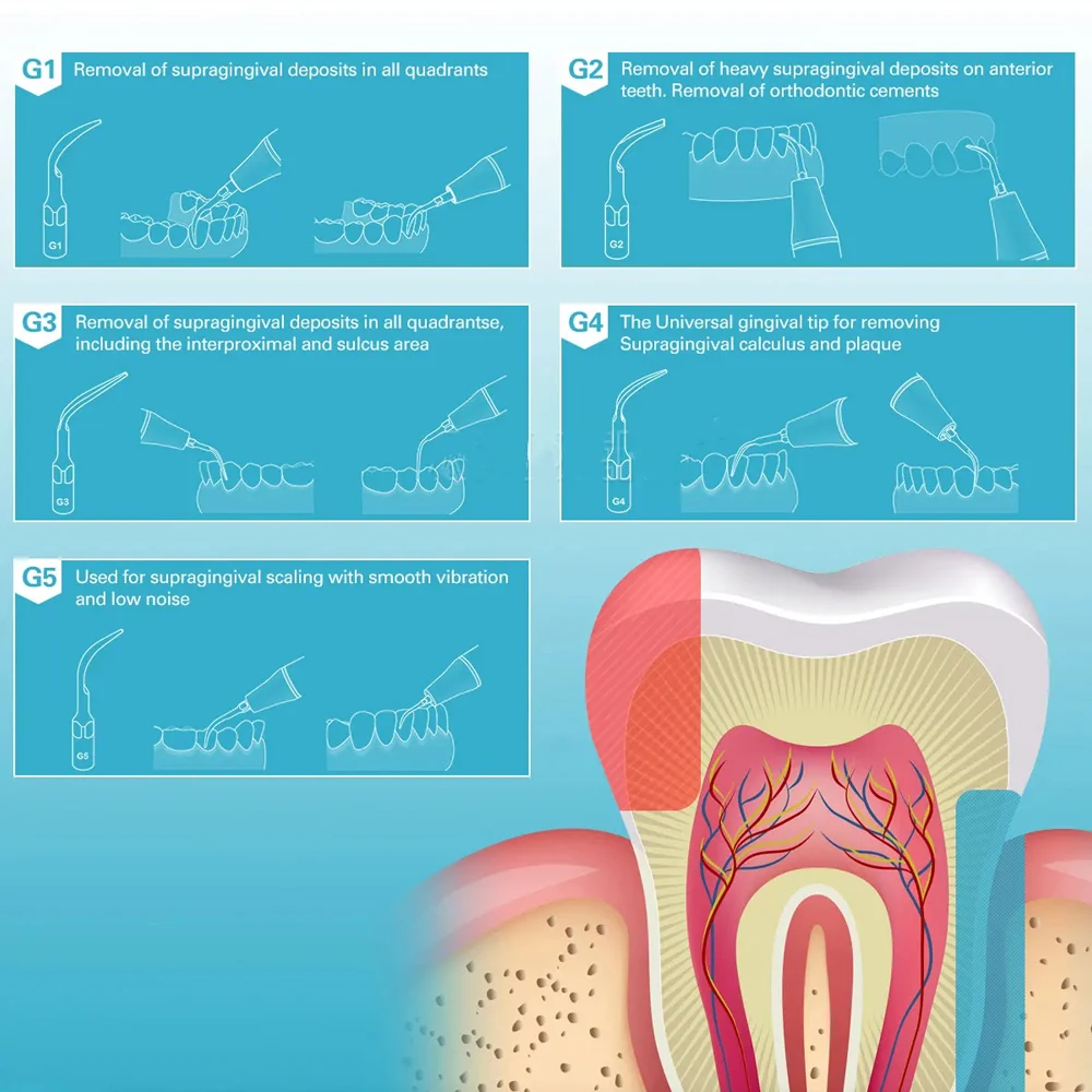 5 قطعة مبيضة أسنان نصائح صالح EMS نقار الخشب بالموجات فوق الصوتية قشارة قبضة الأسنان بالموجات فوق الصوتية قشارة التحجيم تلميح