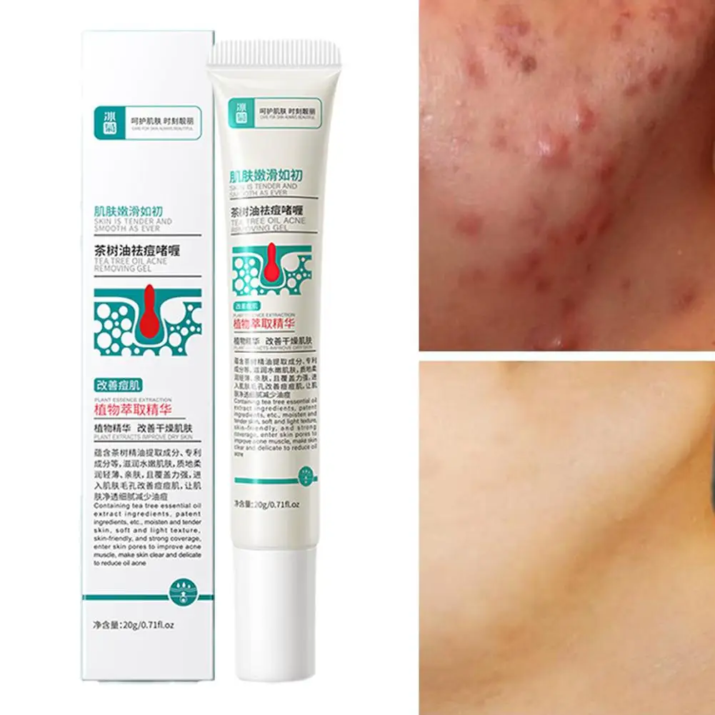 Creme anti-inflamatório do óleo da árvore do chá, reduzir espinhas da acne, controle das nádegas, equilíbrio delicado, umidade da pele, anti-inflamatório, 20g, S V5U5