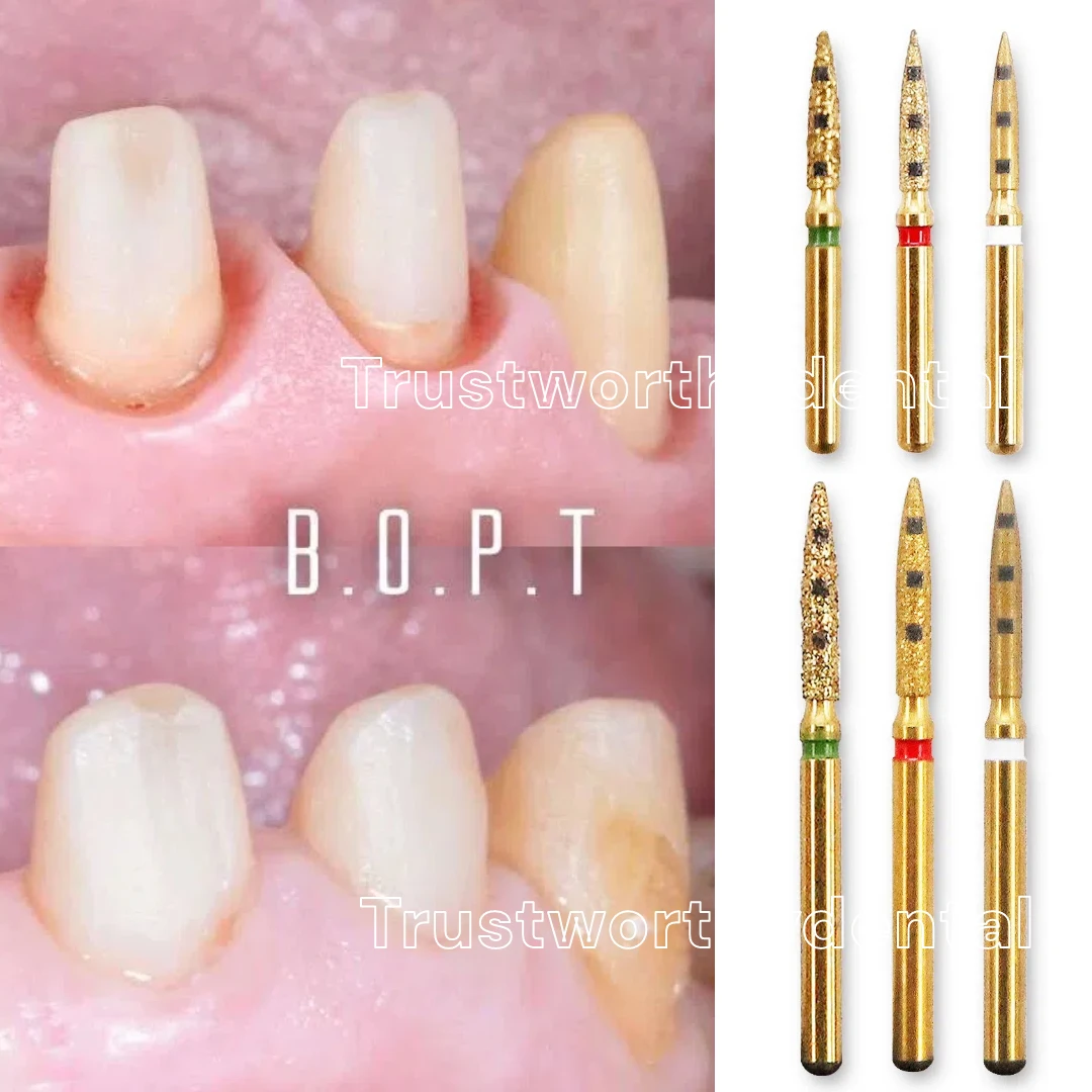 Dental Preparation Bur BOPT Vertical Dental Preparation Restoration Kit Full Crown Restoration Dental Tools FG7906