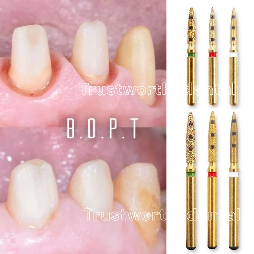 Preparación Dental fresa BOPT Kit de restauración de preparación Dental Vertical herramientas dentales de restauración de corona completa FG7906