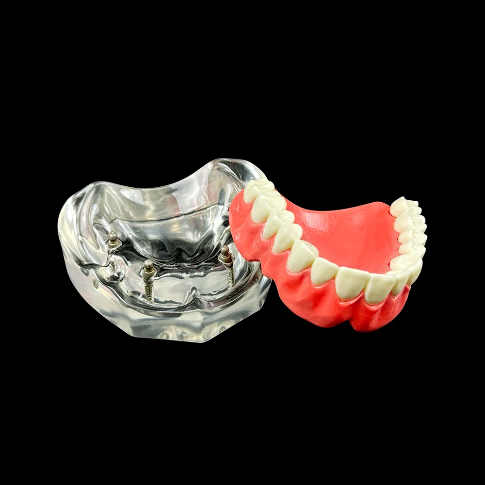 

Стоматологическая модель со съемными и восстанавливающимися зубами. Модель стоматологического образования 4. Зубы имплантата. Для исследований медицинского языка.