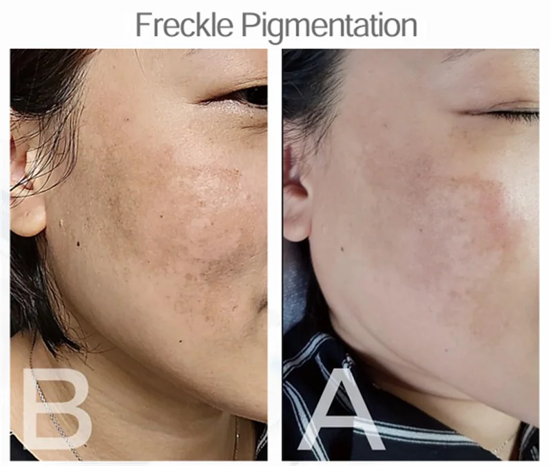 Máquina profissional de beleza anti-envelhecimento, plasma frio, dispositivo de plasma frio, controlador inteligente de problemas de pele, semi-permanente