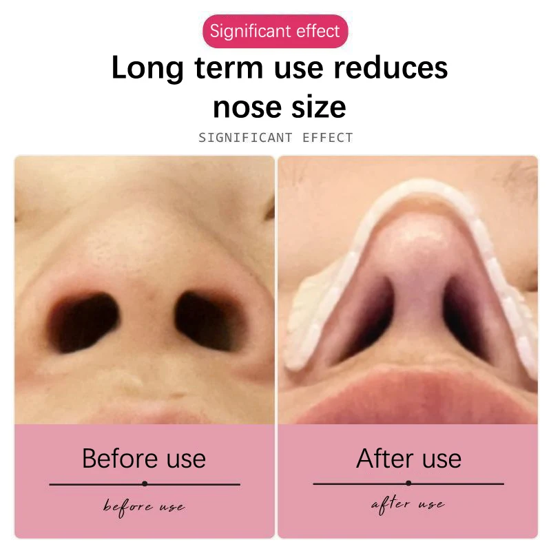 Low Temperature Thermoplastic Nasal Splint Plastic Surgery Plastic Plate Orthopedic Orthopedic Fixator