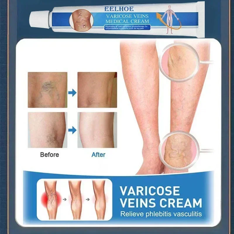 

Varicose Vein Repair Tongmai Effective Relieves Leg Bulge Pain Treatment Vasculitis Phlebitis Remove Vein New