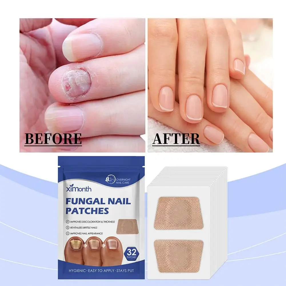 32 Pcs Paronychia Treatment Patch Fungus Removal Nail Correction Stickers Ingrown Nails Recover Pedicure Tools Repair Patches