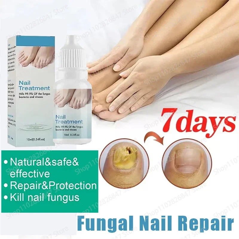 Onychomycosis reparatie serumzalf Onychomycosis paronychia zorgcrème Nagel teennagel voetverzorging reparatie Essence Oil