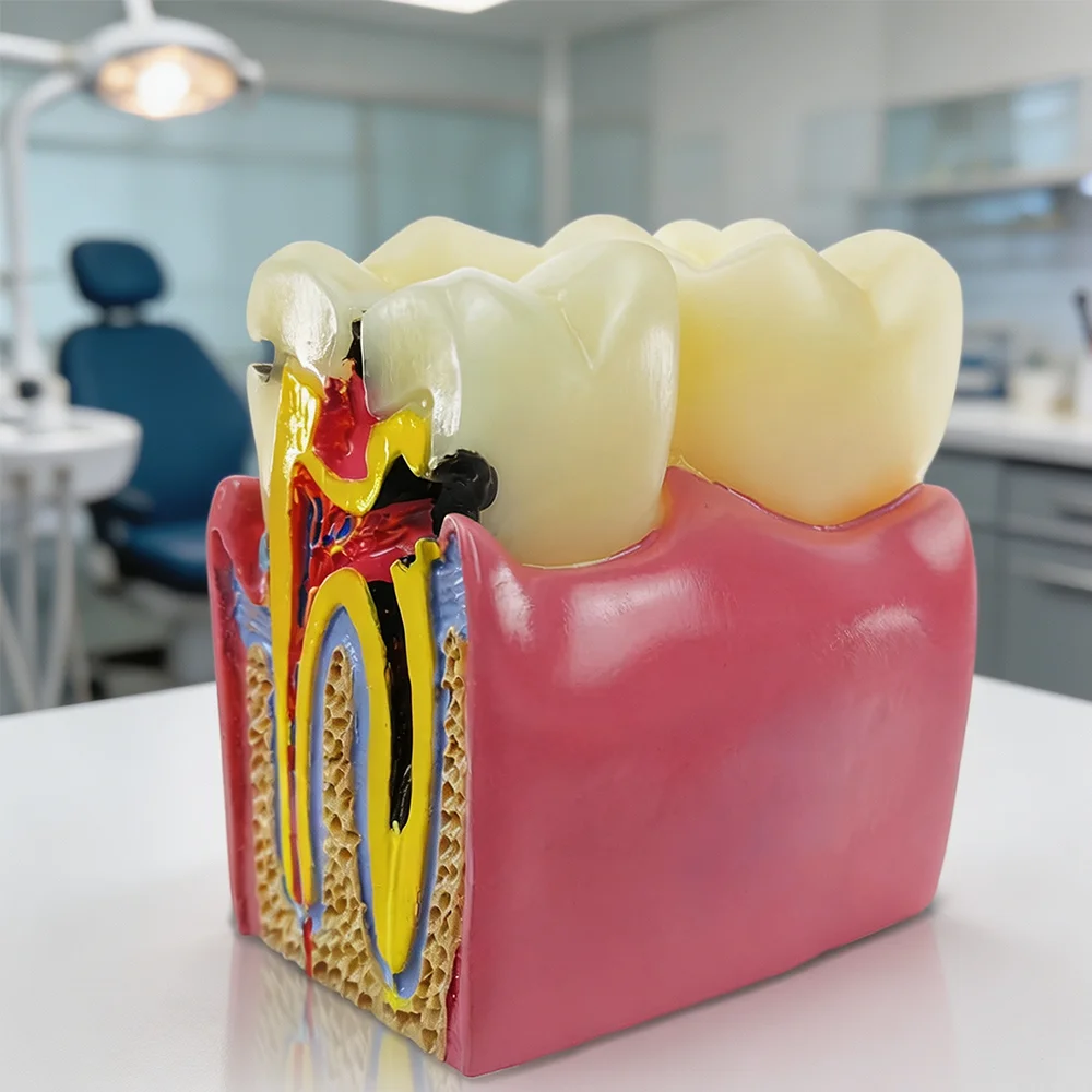 Caries Tooth Model, 6X Magnification Tooth Decay Comparison Study Model, Caries Bilateral Comparison Pathological Tooth Model, Dental Teaching and Learning Tool, for Patient Education and Explanation