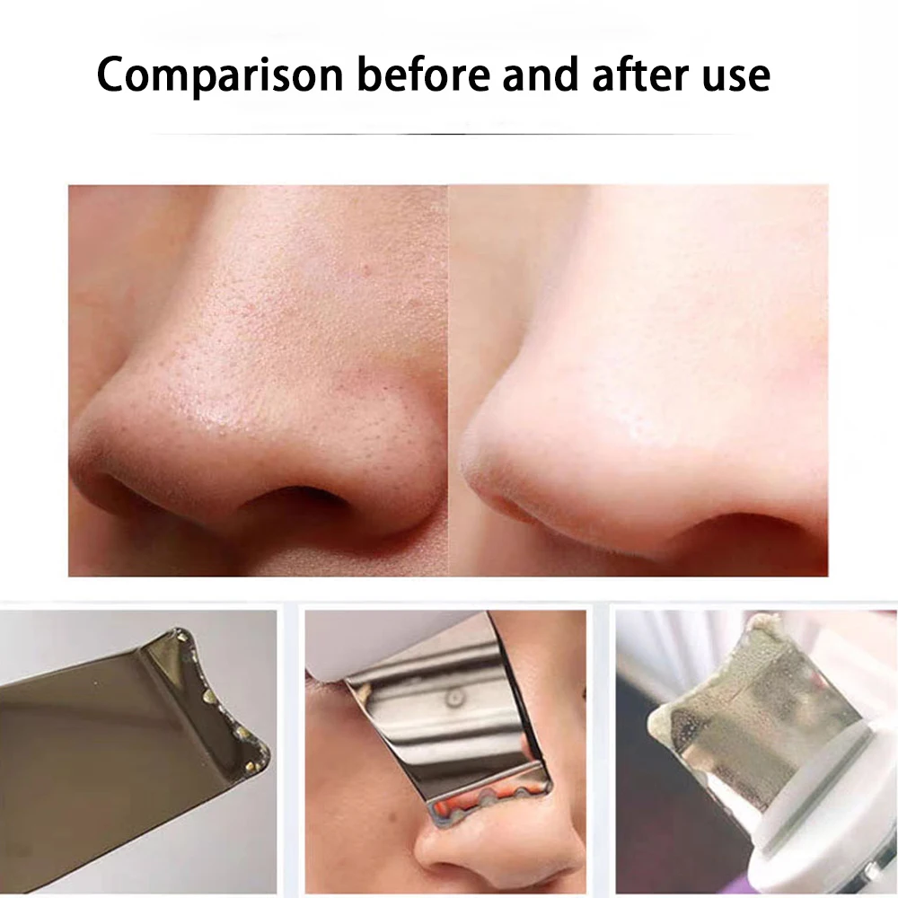 Blackhead Remover Deep Facial Cleansing Spatula Face Cleaning Lift Machine Peeling Shovel Pore Cleaner Black Dot Sebum remover