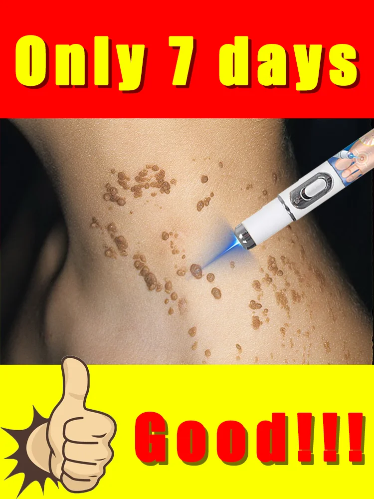 Niebieski długopis na brodawki, nowość 2025, popularne narzędzia do pielęgnacji brodawek, darmowa wysyłka, rozwiąż swoje problemy