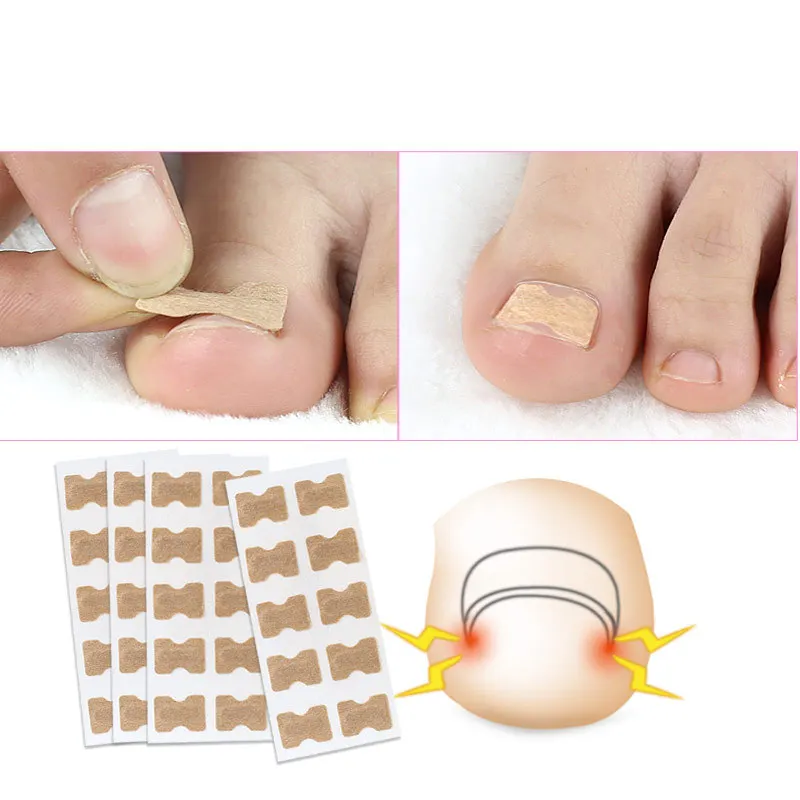 20 piezas Corrector de uñas de los pies pegatina paroniquia tratamiento fijador recuperar Corrector pedicura pie herramienta para el cuidado de las uñas sin pegamento