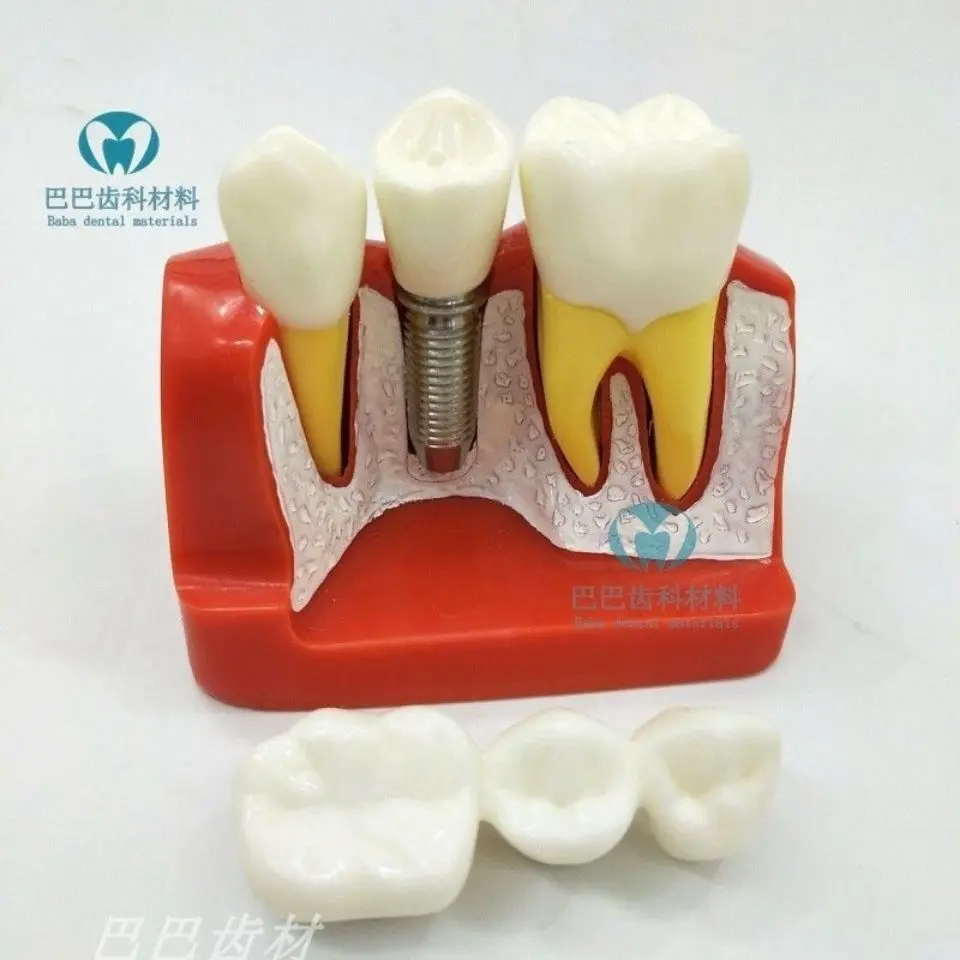 Oral and Dental Model 4 Times Implant Explanation Model, Crown Removable Implant Nail Display Model, Doctor-patient Communicatio