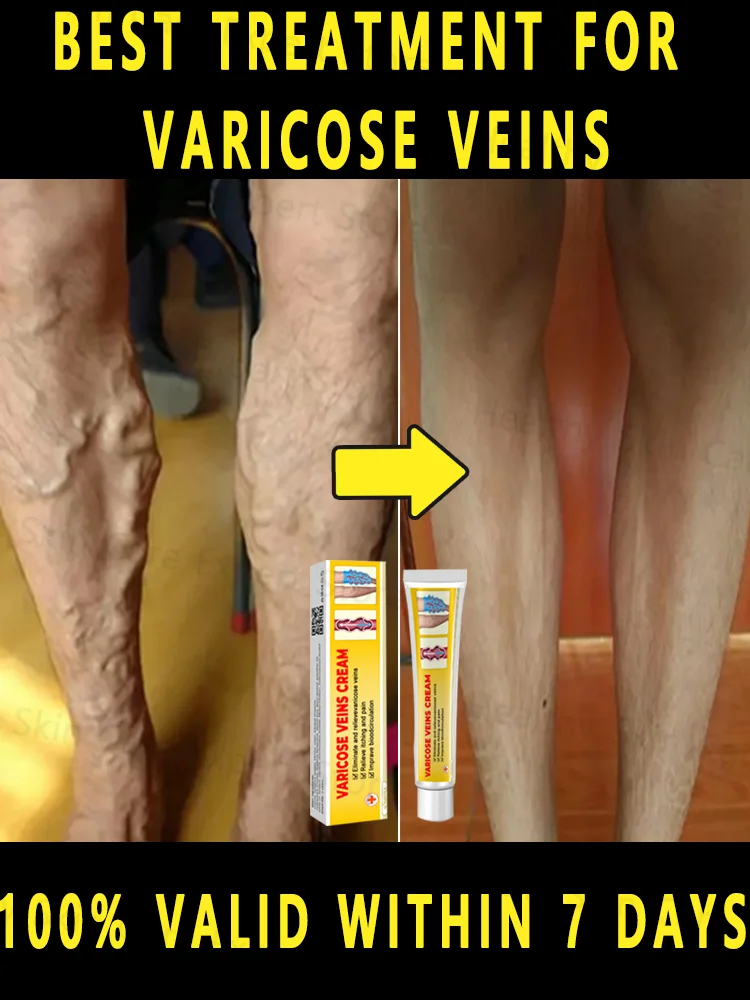 

All Natural Varicose Vein Treatment