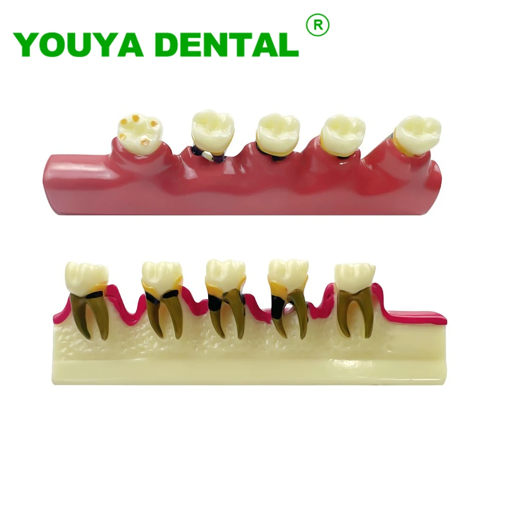 Dental Disease Model Teeth Periodontal Caries Breakdown Display Teaching Tooth Model Dentist Communication Demonstration Tools