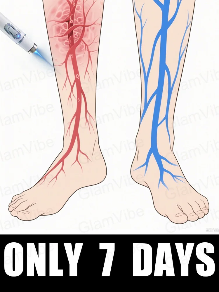 

blue light pen solve varicose veins, hot sale leg care tools