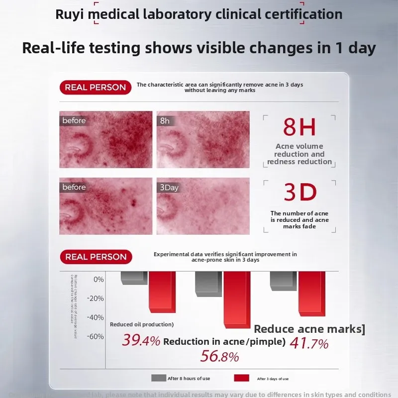 RUYI كريم وجه ترطيب إصلاح تفتيح علامات حب الشباب الحفر ترطيب الجمال الصحة تقليص المسام العناية بالبشرة كريم وجه