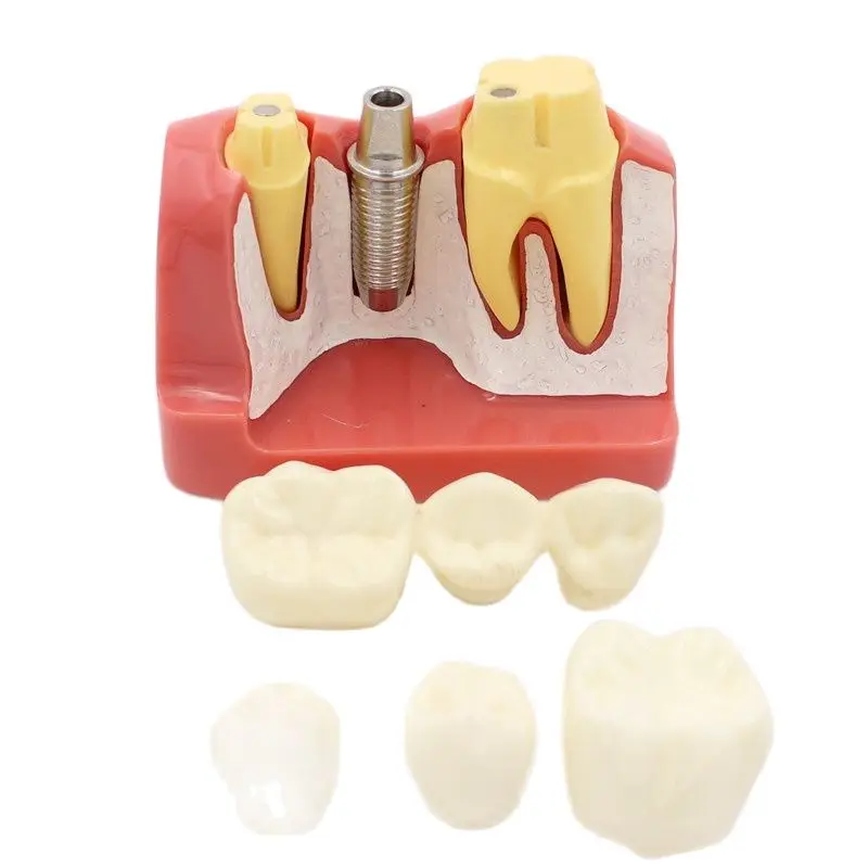 Dental Teach Implant Analysis Crown Bridge Removable Model Dental Demonstration Teeth Model