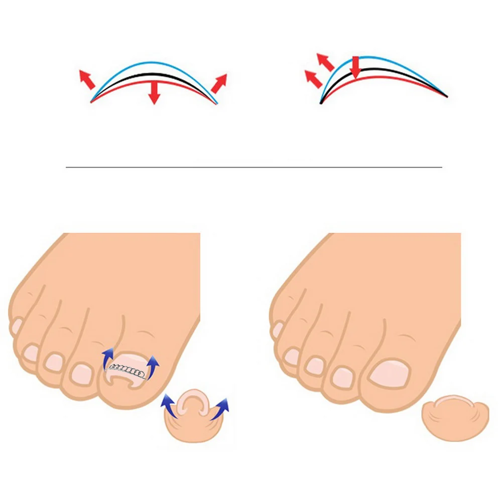 /صندوق نام أظافر تصحيح سلك المثبت 6 أحجام نام تو مصحح باديكير علاج العناية بالقدم أداة العناية بالقدم أداة