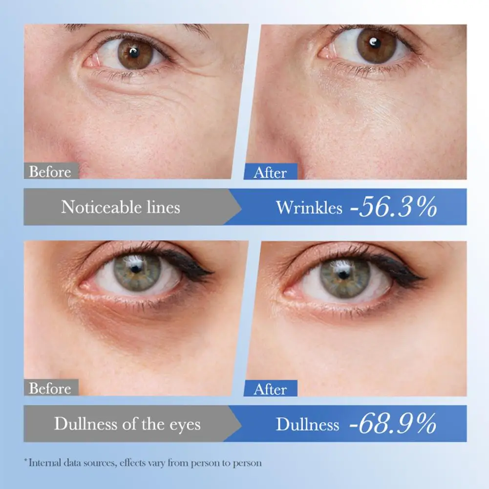 1/2/3pcs SADOER Caviar Hyaluronic Acid Eye Cream Anti Dark Circles Removal Eyes Bags anti-aging Moisturizing Eyes Skin Care - view 5