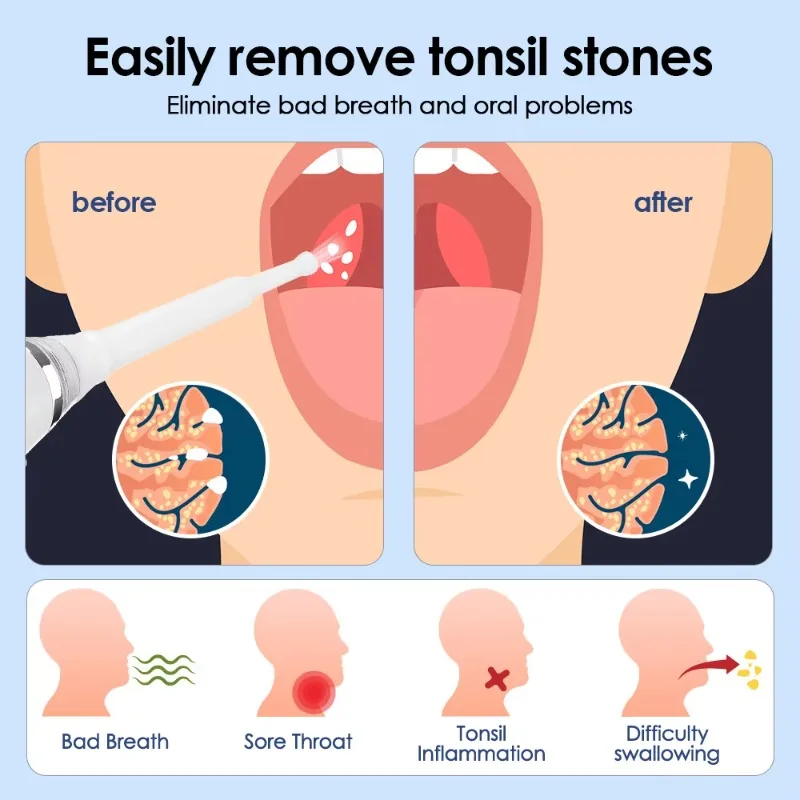 Smart Water Pulse Tonsil Stone Remover Kit with Light Emitting Diode Electric Vacuum Tonsil Stone Remover