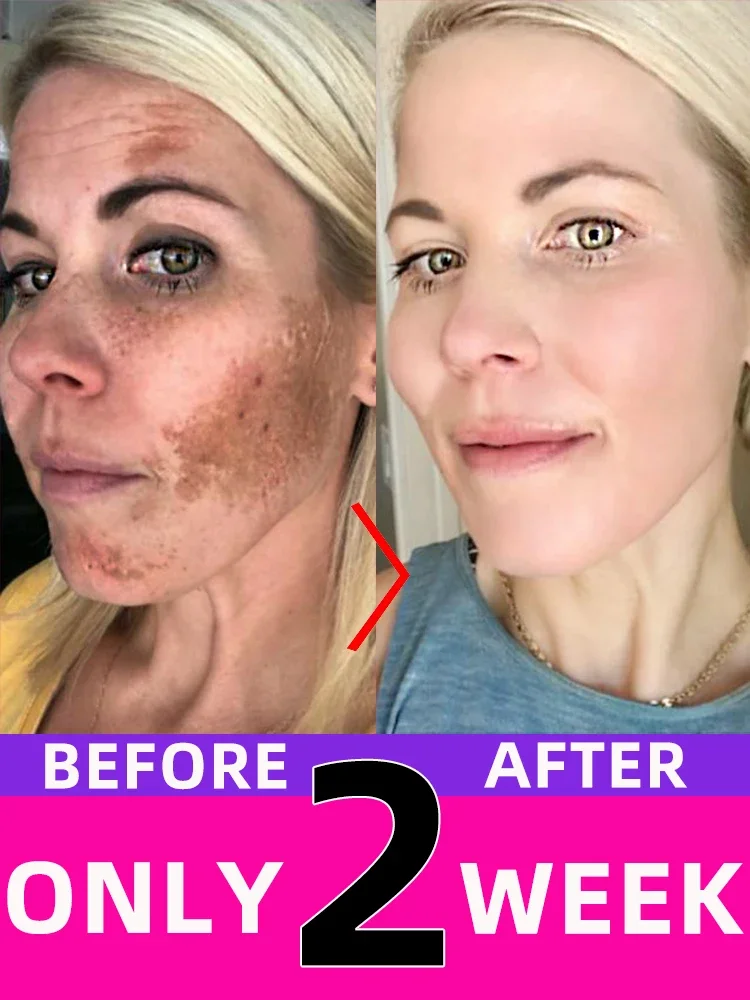 

Freckles Chloasma Sun Age Dark Spot Clear