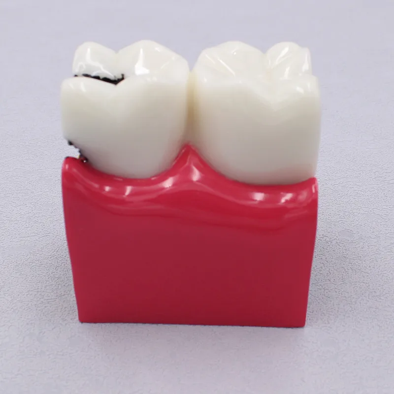 Modelo dental dos dentes do laboratório para o dentista, materiais do estudo para estudar e pesquisar, 6 vezes cárie, 1PC