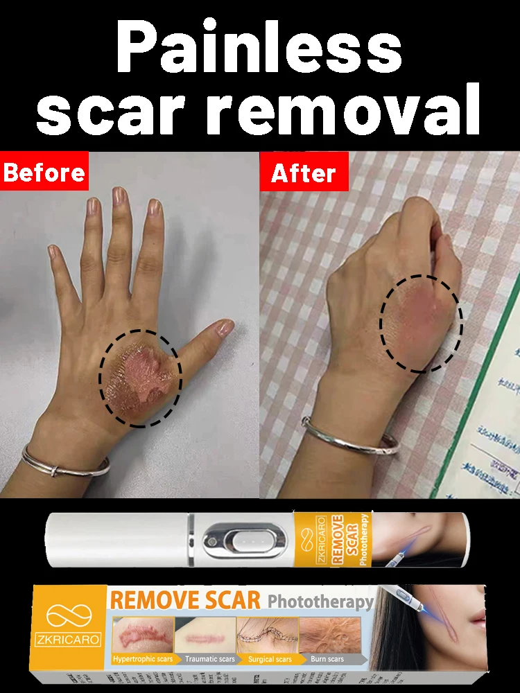 

Repairing postoperative pimples is effective for both new and old scars
