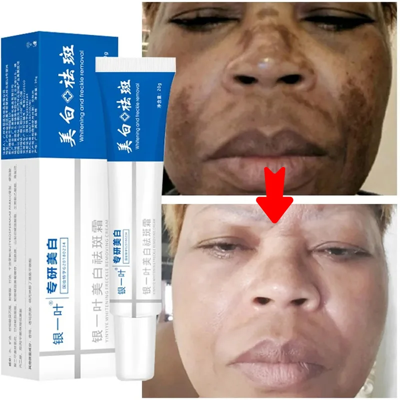 Effective whitening Freckle Cream Remove Melasma Dark Spots Cream Fade Melanin Moisturize Brighten Smooth Beauty Face Skin care