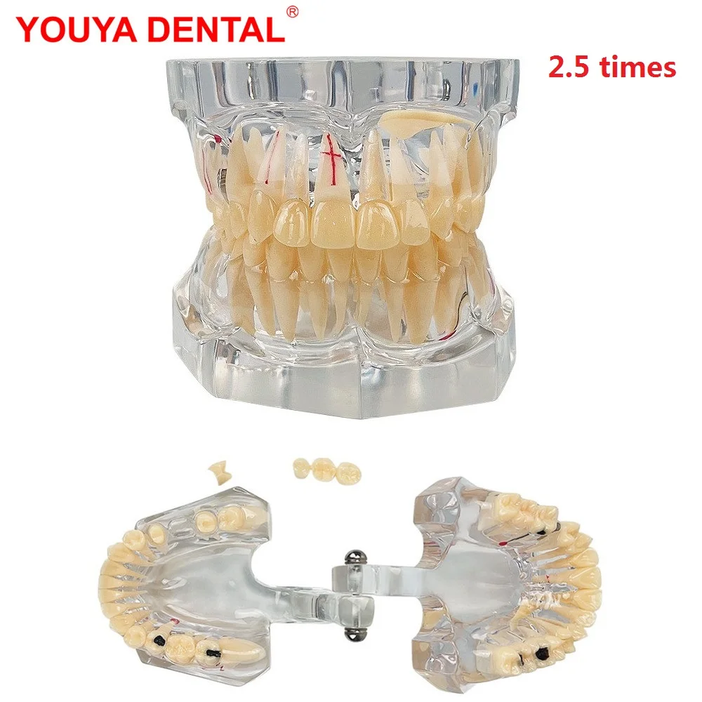 2.5 Times Dental Models For Patient Education Dental Teeth Model With Removal Teeth Clear Jaw Model Dentistry Pathology Typodont