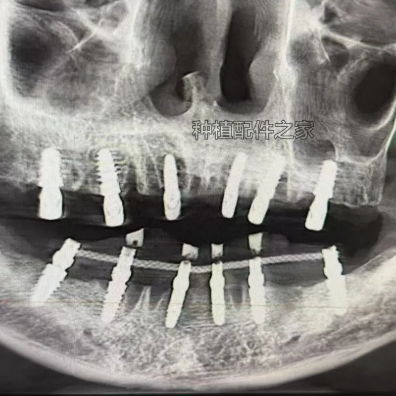 1/5/10pcs Dental Implant Connector Stainless Wire Overdenture MU Wires Strengthener 100mm Full Arch Implant Connecting Bars ﻿