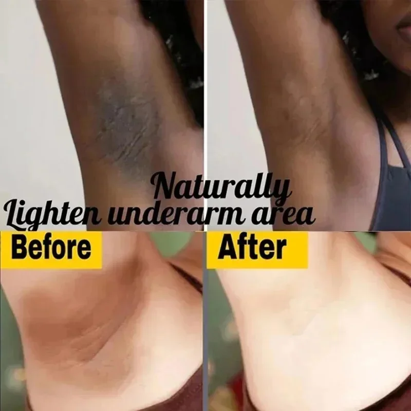 Brightening Cream For Dark Skin Effective Lighten Thigh Inner Bleach Remove Melanin Private Part Elbow Knees Brighten Skin Cream