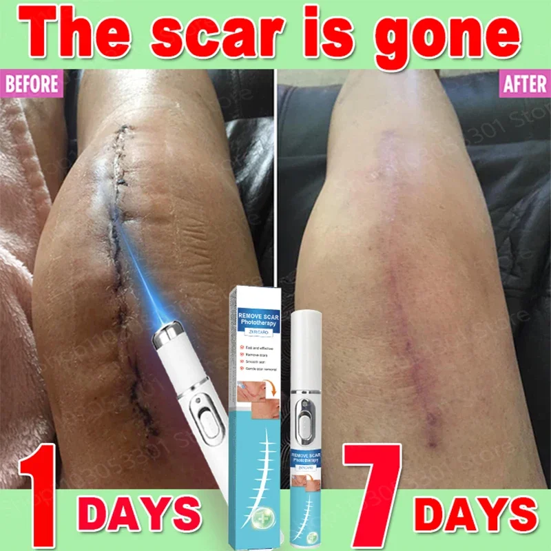 Best selling product, scars are gone！！！