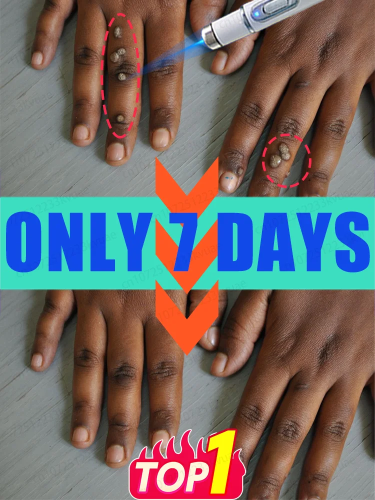 Herramienta de eliminación de verrugas más vendida, haga clic para pedir ahora y cambiar tu vida